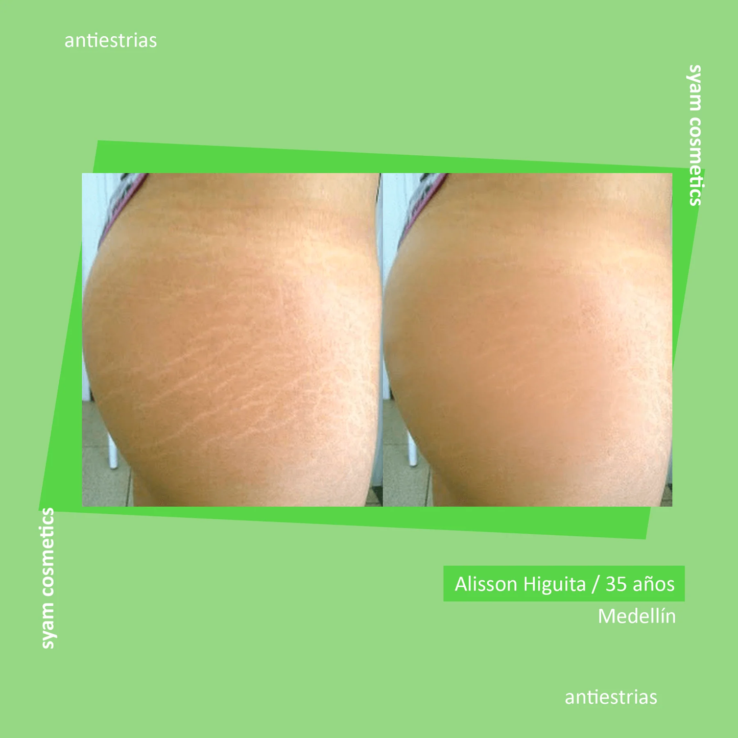 ACEITE ANTI ESTRIAS PIEL DE ORO